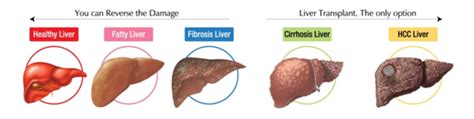 Miot Liver Gym An Initiative To Reverse Liver Damage