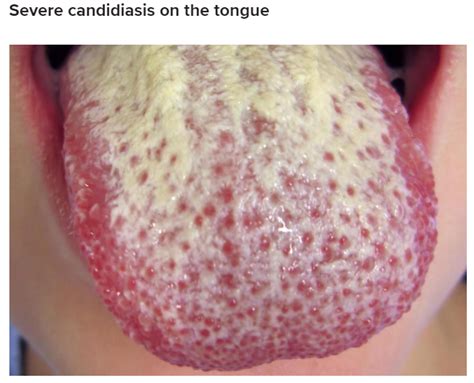 Do Not Lick Your Partner Thrush Candida Infection Yourhealthcare