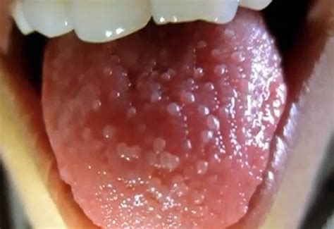 transient lingual papillitis  lie bumps   lie bumps treatment