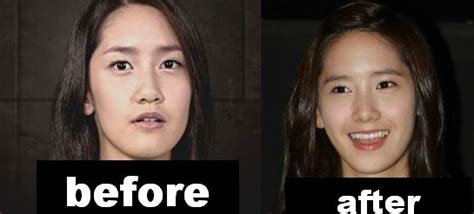 Yoona Plastic Surgery Before And After Eyelid Surgery And