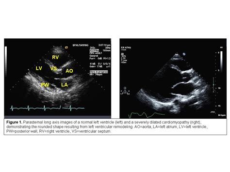 Use Of The Echocardiogram To Define The Presence Extent And Etiology