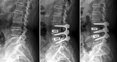 Typical Instrumented Lumbar Interbody Fusion L3 4 And L4 5