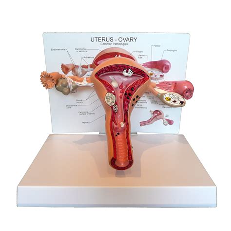 anatomical human pathological uterus and ovary model