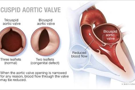 Mayo Clinic Qanda What Is A Bicuspid Aortic Valve
