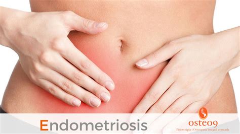 osteo9 endometriosis parte i
