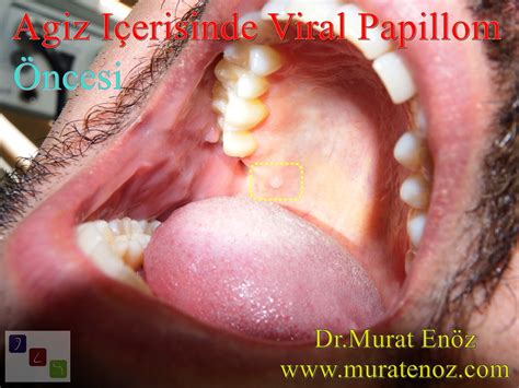 Oral Human Papillomavirus Hpv Infection Symptoms