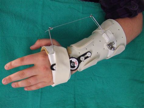 principles  splinting splinting  wrist  hand conditions