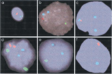 Fluorescence In Situ Hybridization Of Klinefelter Syndrome Patient S
