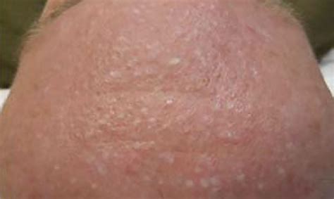 cosmetic problem facial papules  birt hogg dube syndrome