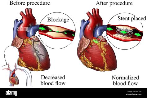 bloqueo arterial fotografias  imagenes de alta resolucion alamy