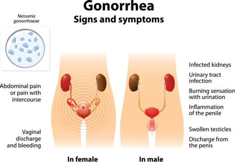 Gonorrhea Health Nigeria