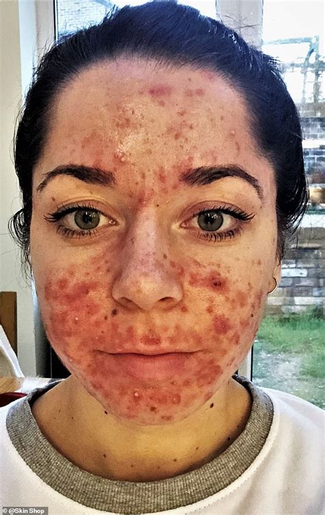 Woman Who Was Bullied At School Due To Severe Acne Has Seen