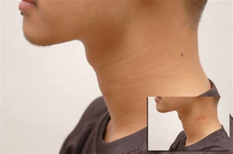pin on hickey removal tips
