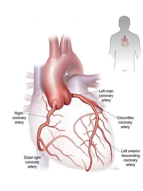 coronary artery disease  coronary bypass surgery baylor medicine