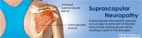 Suprascapular Neuropathy Definition Treatment Causes Symptoms