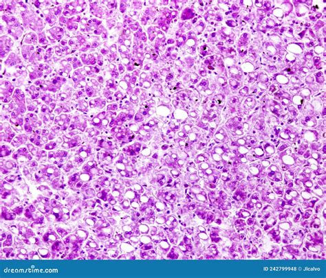 human liver steatosis pas stain stock photo image  alcoholic histopathology
