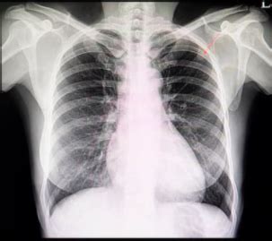 lung nodules pulmonary associates  richmond