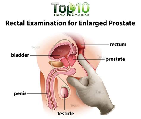 home remedies for enlarged prostate top 10 home remedies