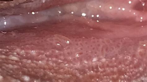 Please Help I Dont Know What It Is And Im Scared Is It Herpes