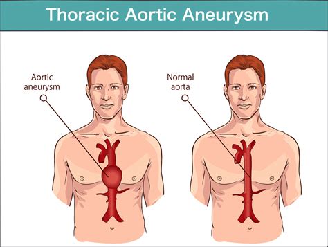 thoracic aortic dissection vrogueco