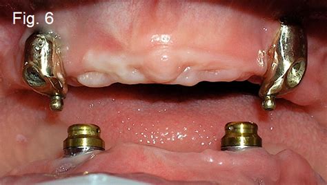 Maxillary Prosthesis Retained By Two Dental Implants