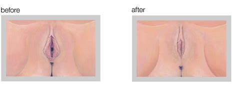 Labiaplasty Los Angeles Cosmetic Gynecology