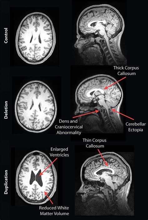 mri reveals striking brain differences  people  genetic autism