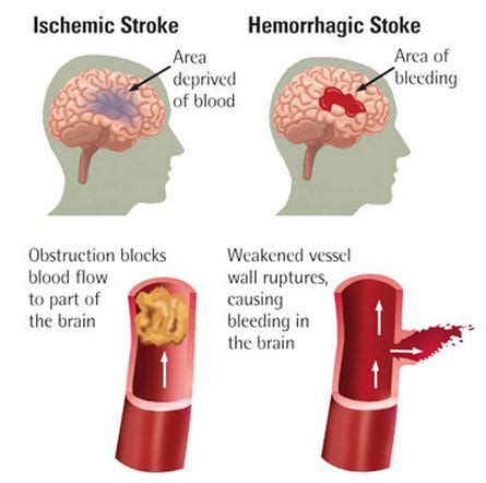 cell therapy hold  key  treating stroke seeking alpha