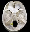 Bildergebnis für Foramina parietalia magna. Größe: 99 x 106. Quelle: en.wikipedia.org