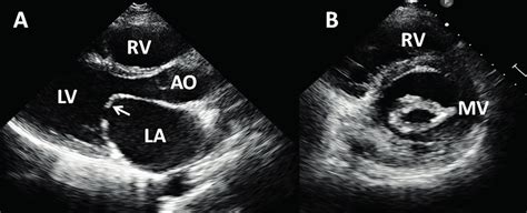 Transthoracic Echocardiography From Patient With Severe