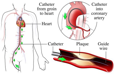 cardiac catheterization  cardiac catheterization nhlbi nih