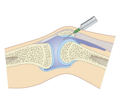 Synovial Or Joint Fluid Analysis