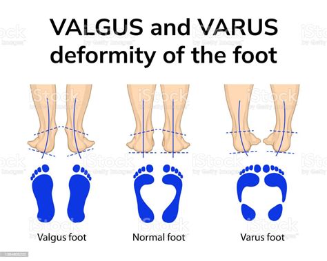 varus  valgus deformity   foot stock illustration