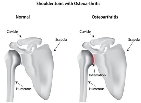 osteoarthritis   shoulder  buxton osteopathy clinic
