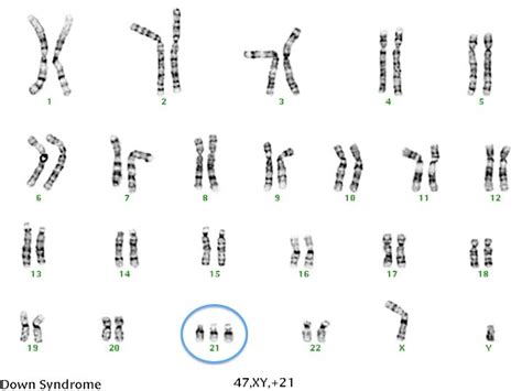 Gene Mutation In Sickle Cell Anaemia And Chromosome