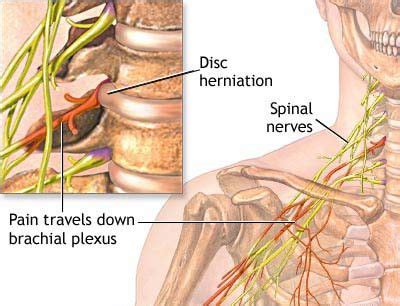 treatment  pinched nerve   neck  nj pain management doctor