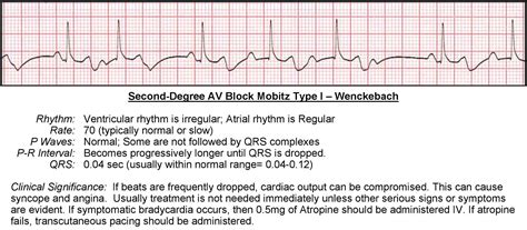 Atrioventricular Blocks Acls Wiki