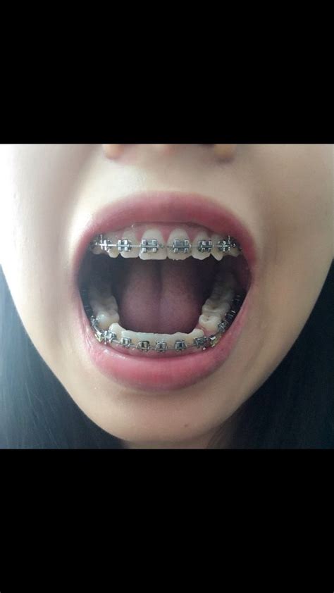 pin by shrood burgos on beautiful braces braces tips cute braces