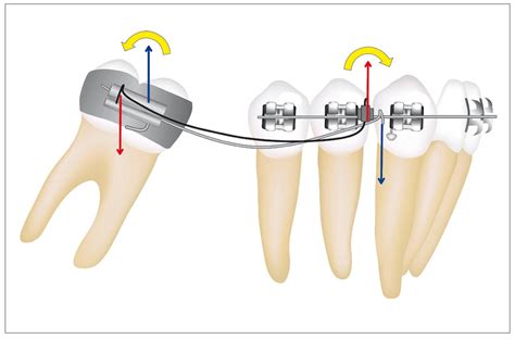 molar uprighting molar uprighting corrects  tilted molar molars