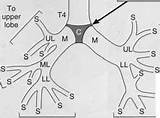 Tracheobronchial Tree Considerations Clinical Lobe Upper sketch template