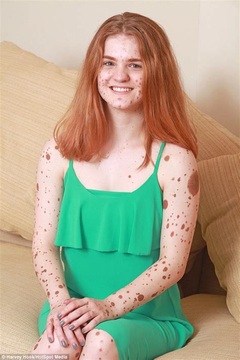 manchester girl covered in birthmarks was bullied for