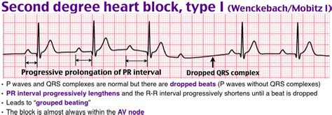 Second Degree Heart Block Cardiology Pinterest