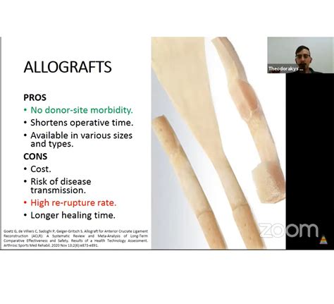 graft selection options  acl reconstruction orthopaedicprinciplescom