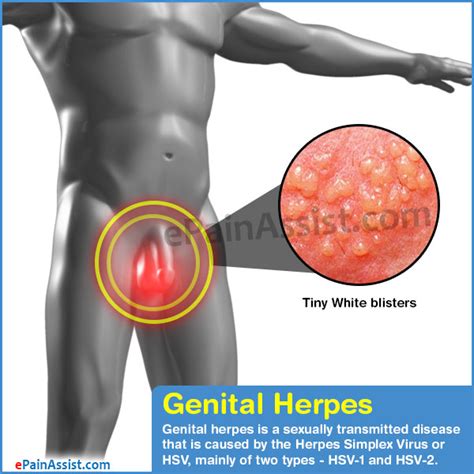 genital herpes from oral sex tubezzz porn photos