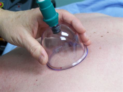 cupping massage laser therapy and massage