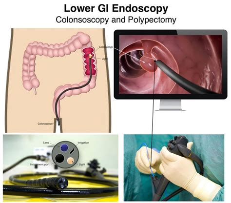 During A Colonoscopy A Video Of The Colon Lining Is Viewed On A