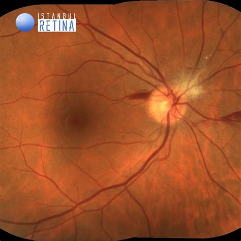 exophytic juxtapapillary retinal capillary hemangioma oct club