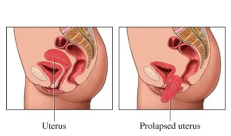 pelvic organ prolapse global women connected