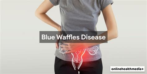 Blue Waffles Disease Does It Really Exist Explanation Of Gynaecologists