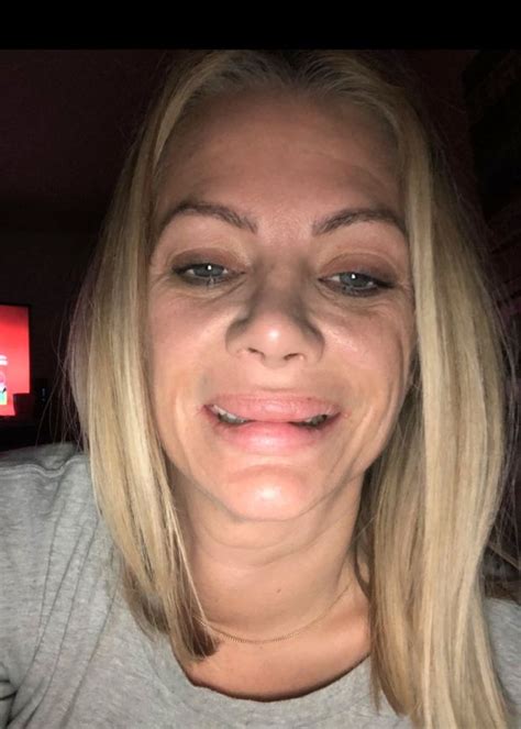 woman left with misshapen lips after several plastic surgeries creepy